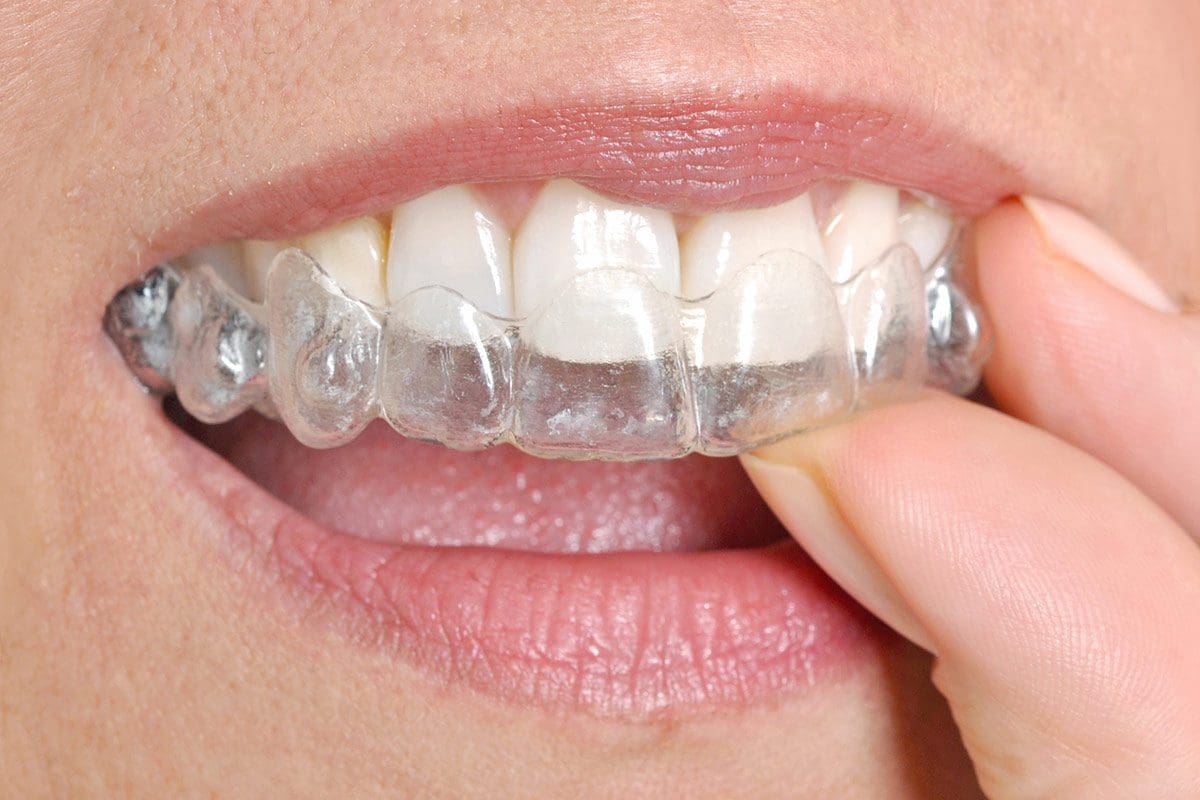 Affollamento Dentale - Dentista Cinisello Balsamo
