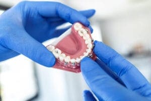 Apparecchio dentale e i tipi di trattamento