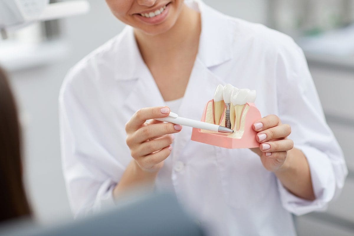 Differenze tra perno dentale e impianto dentale