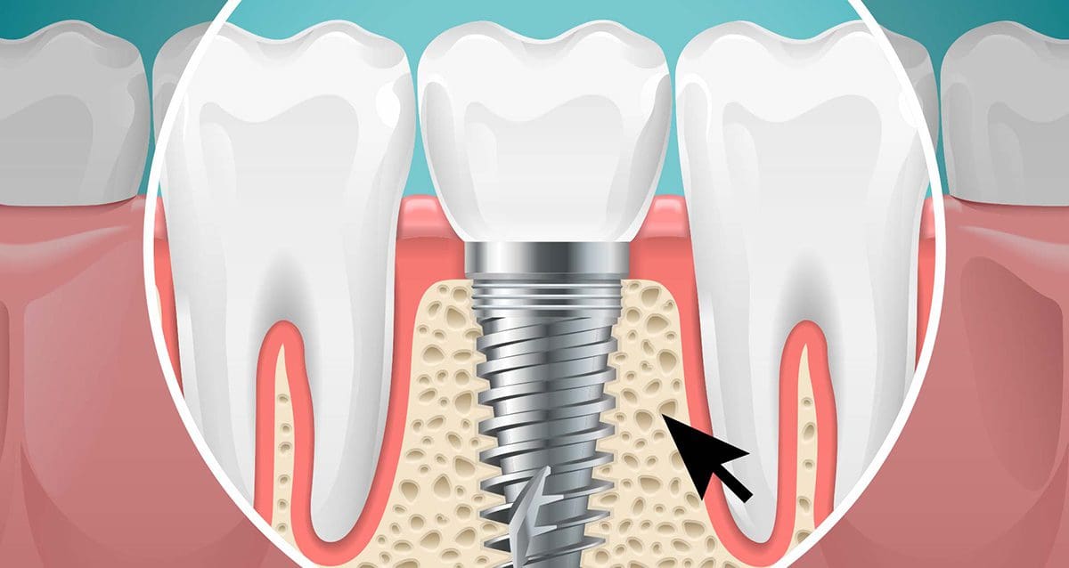 Innesto osseo dentale