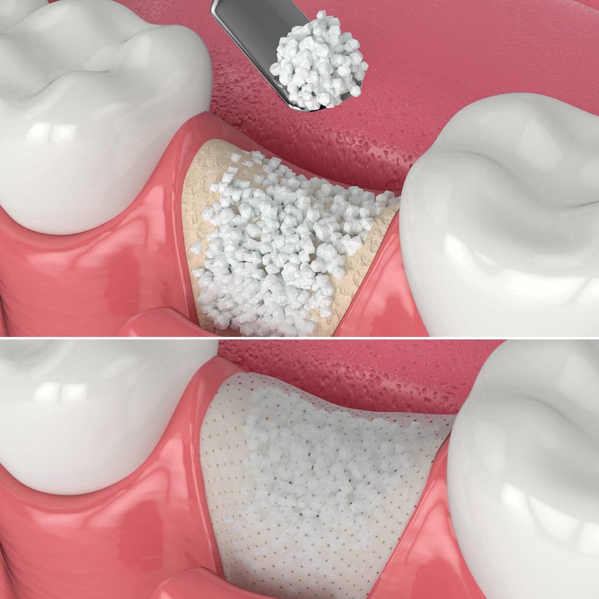 Innesto osseo dentale