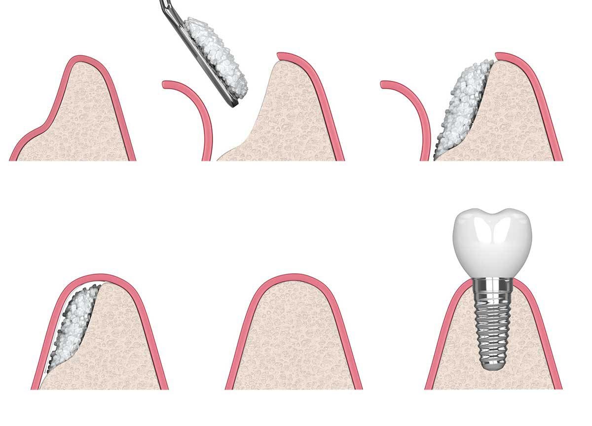 Innesto osseo dentale