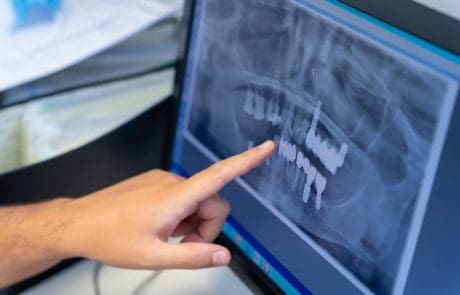 Chirurgia implantare: carico immediato o differito