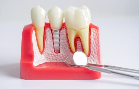 Cosa fare prima e dopo un intervento di implantologia dentale