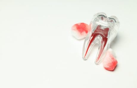 parodontite cause sintomi e trattamenti moderni