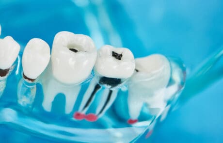 ascessi dentali trattamenti innovativi e cura