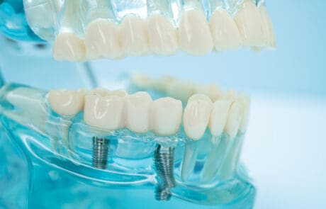 impianti dentali economici in italia