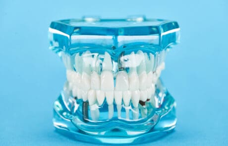 denti fissi senza impianto o con impianto