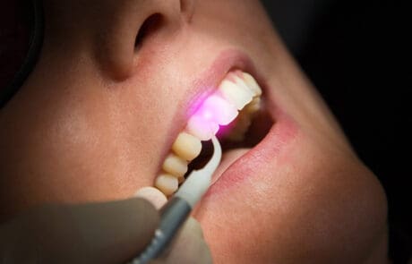 cura per la parodontite laser e trattamenti efficaci