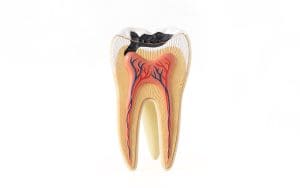 carie denti cause sintomi rimedi prevenzione