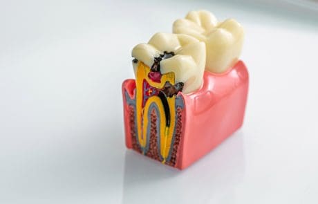 carie denti cause sintomi rimedi prevenzione