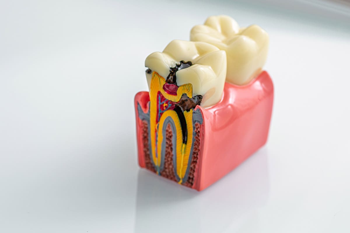 carie denti cause sintomi rimedi prevenzione