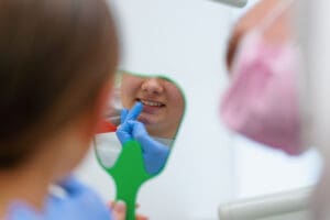 sigillatura dentale nei bambini prevenzione carie efficace